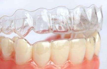 Aparelho dental Invisalign em Itumbiara